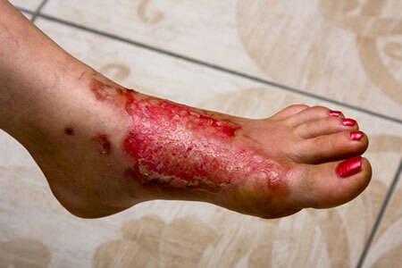Burn Injury